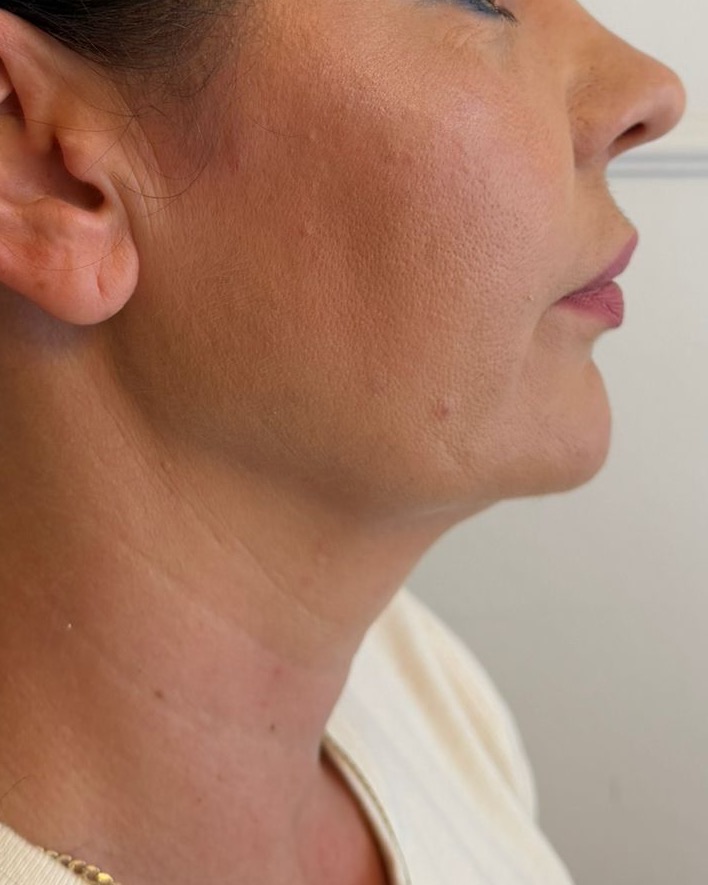 Kinn- und Halslinie im Profil, zweite Aufnahme vier Wochen später